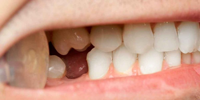 Don’t Let One Missing Tooth Damage the Rest of Your Mouth